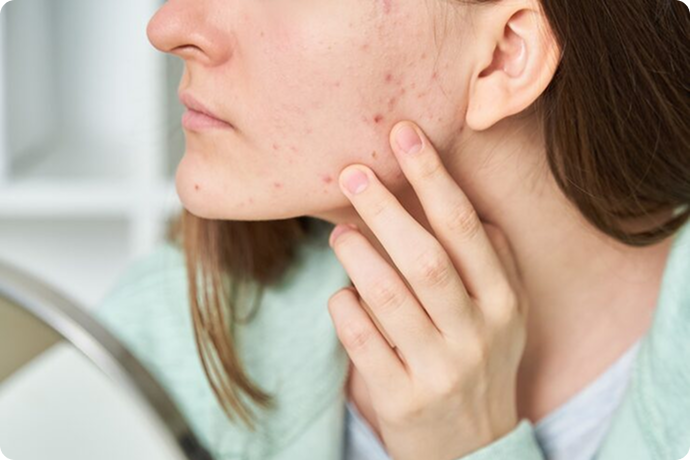 Acne